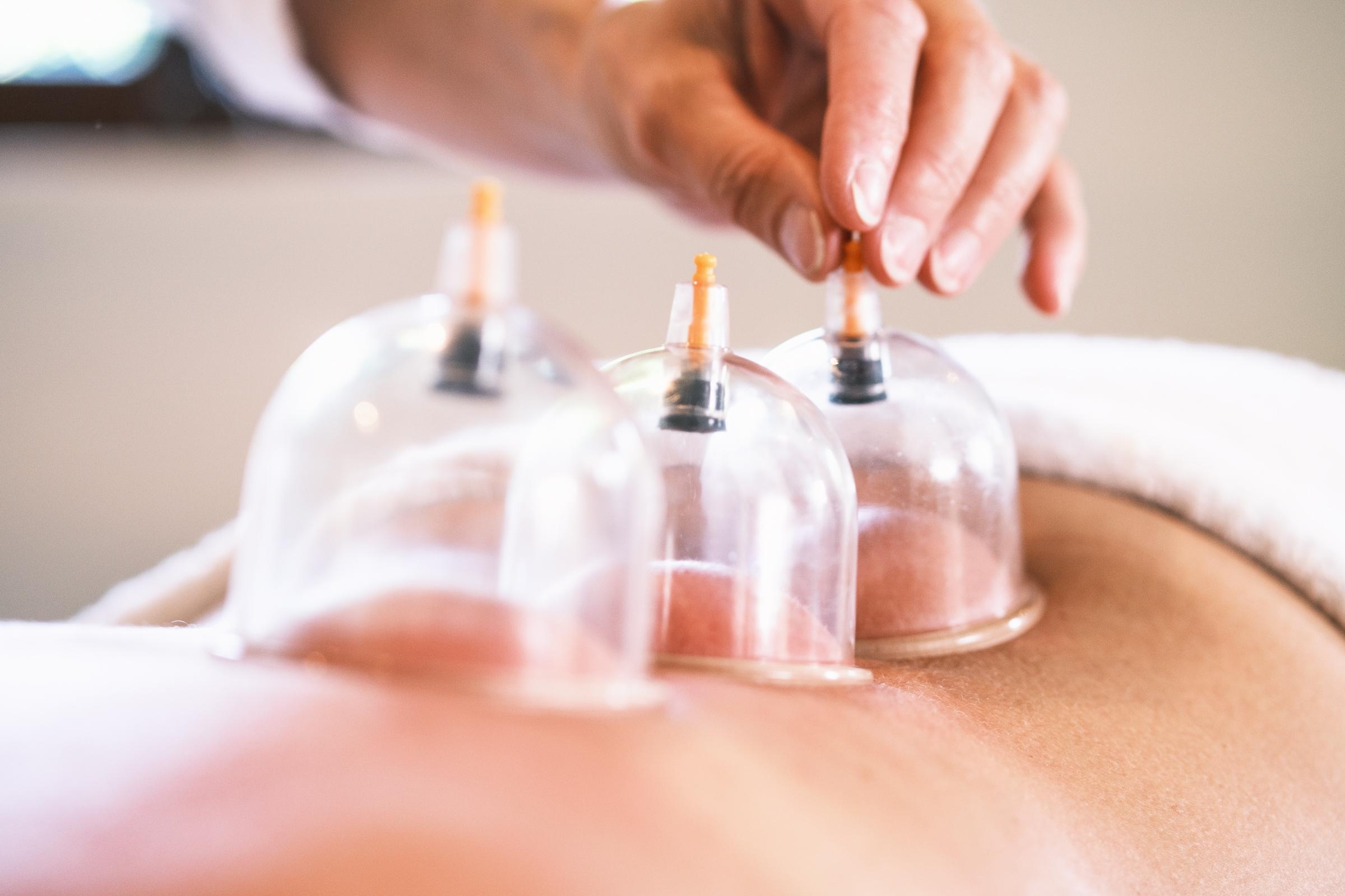 En person placerer sugekopper på en ryg under en behandling med cupping.