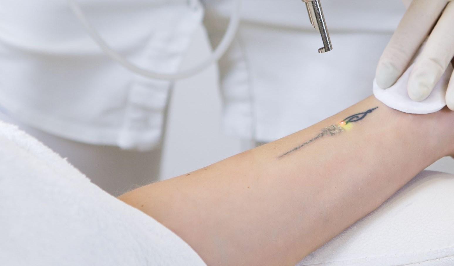 En person får en tatovering fjernet med laserbehandling på armen, mens en behandler holder en vatpind.