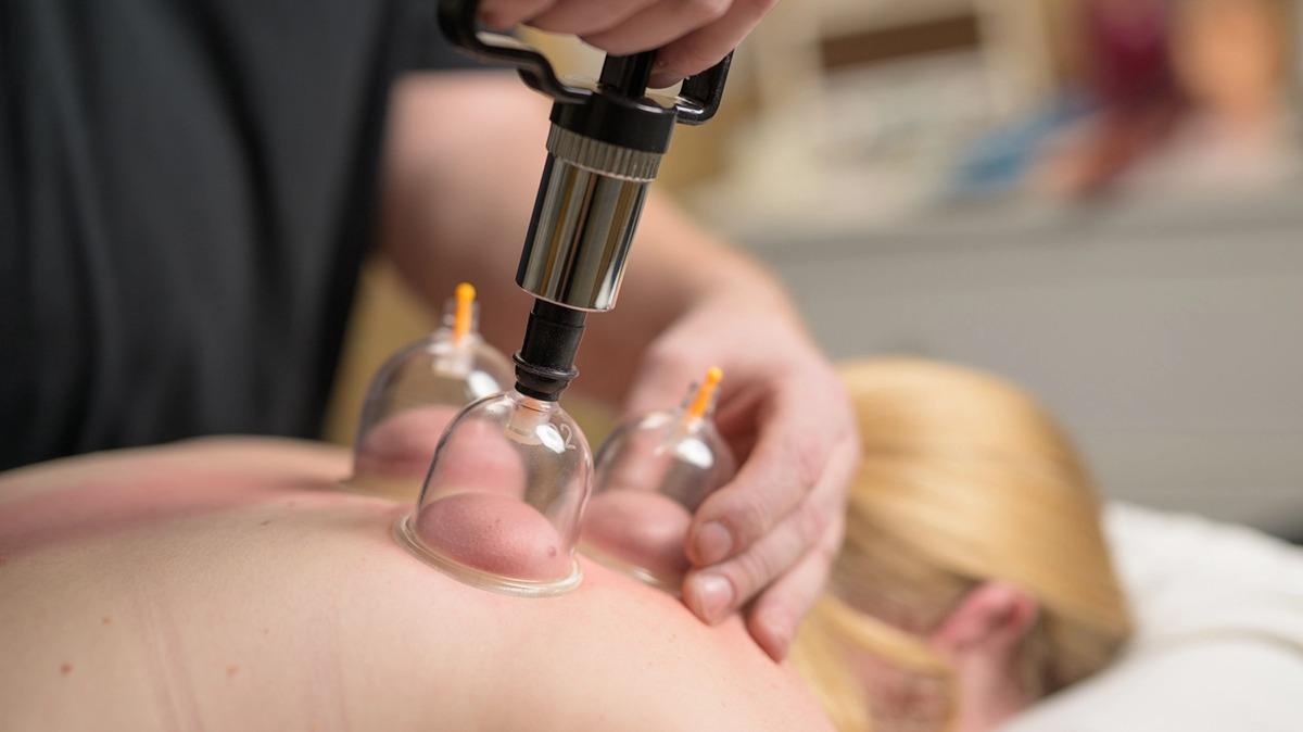 En person får cupping-behandling med glasbeholdere på ryggen i en klinisk indstilling.