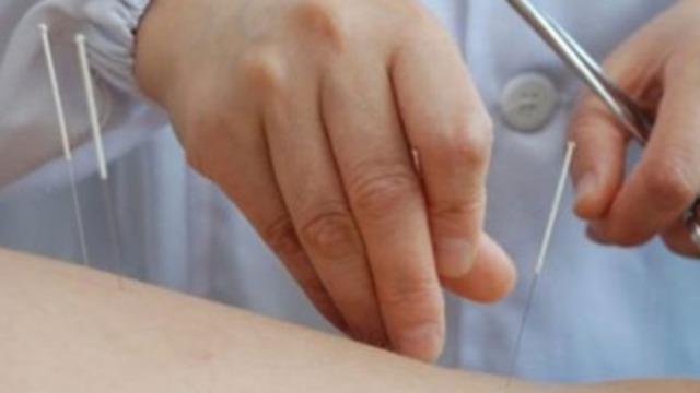 En hånd, der placerer akupunkturnåle på en arm under en behandling.