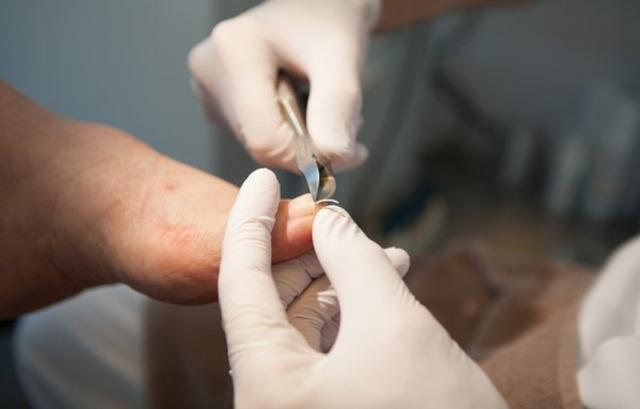 En person får behandling af en fod med handsker og værktøj i en klinik.