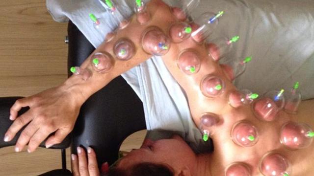 En person får cupping-behandling med sugekopper på ryggen og armene.