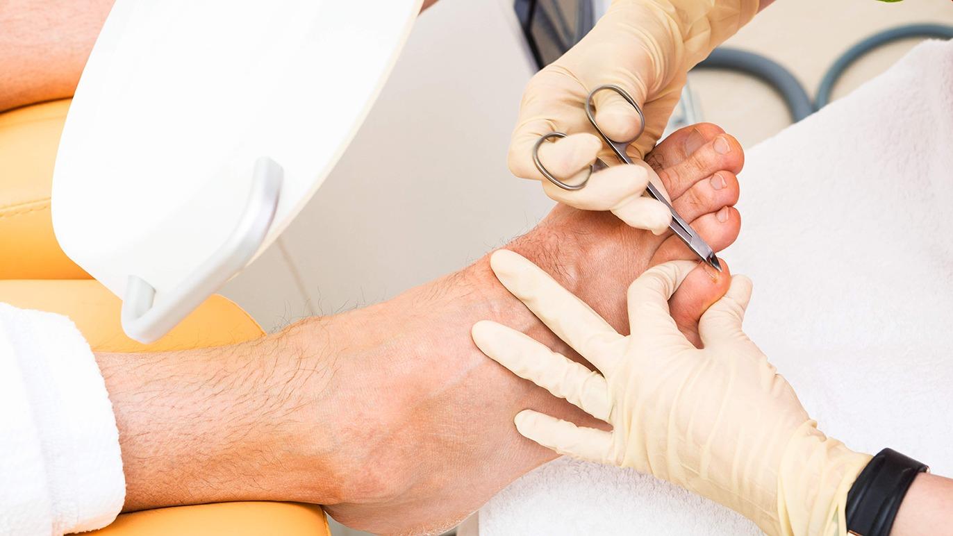 En fodbehandling, hvor en behandler klipper tånegle på en patient iført handsker.