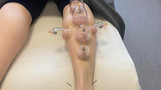 En person får cuppingbehandling med glasbeholdere på benet, der ligger på en hvid pude.